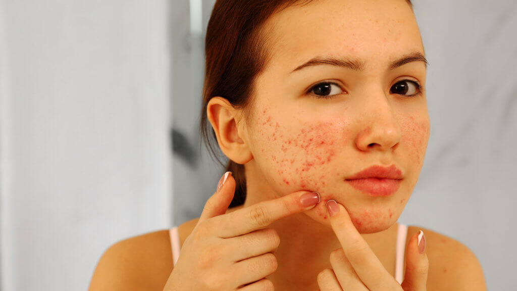 Do you have acne forever?