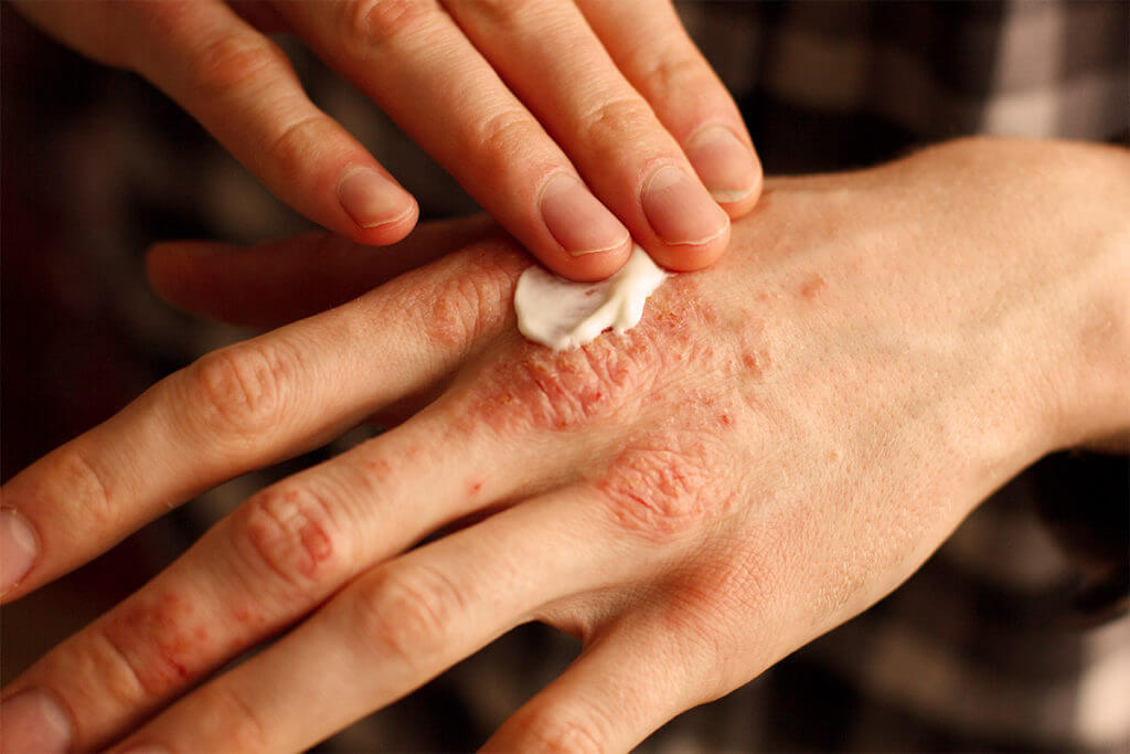 How is atopic dermatitis treated?