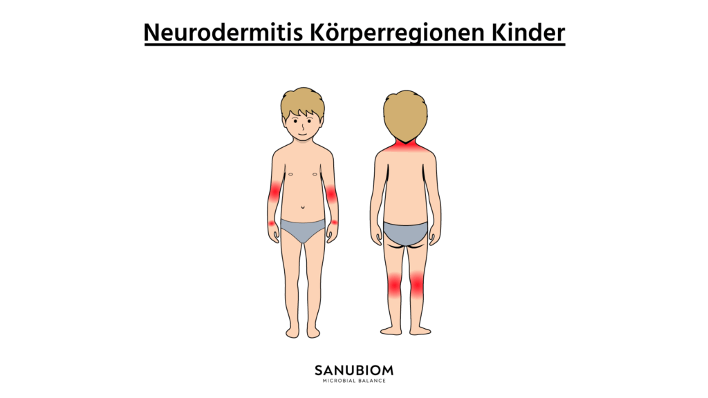 L'eczema cutaneo è spesso presente nelle pieghe delle articolazioni, sulla mano e nella zona del collo.