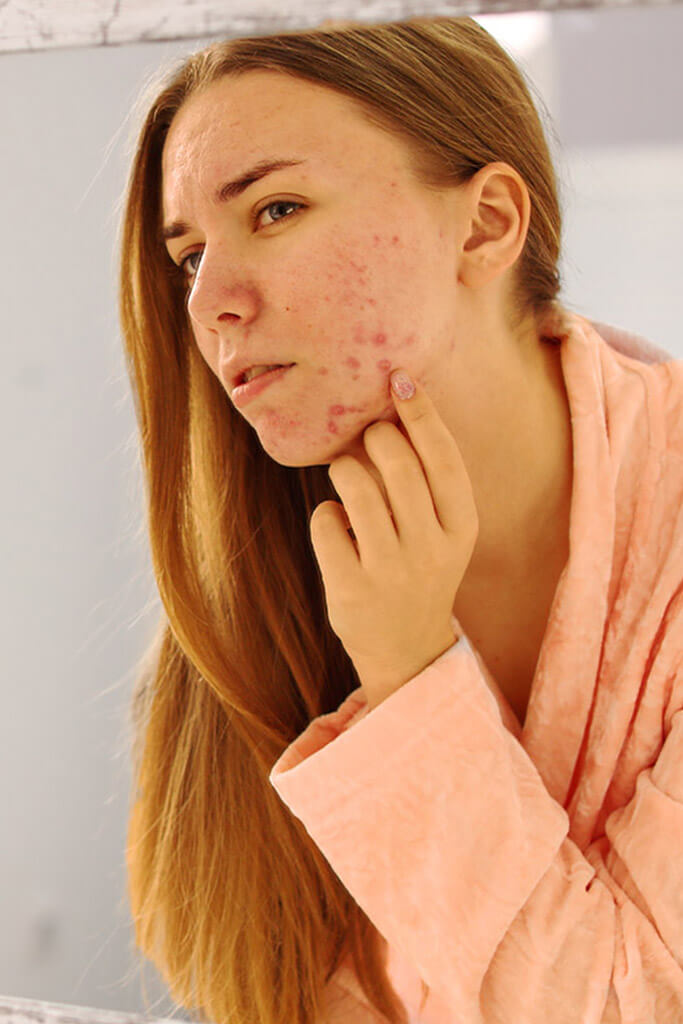 Phage application for acne