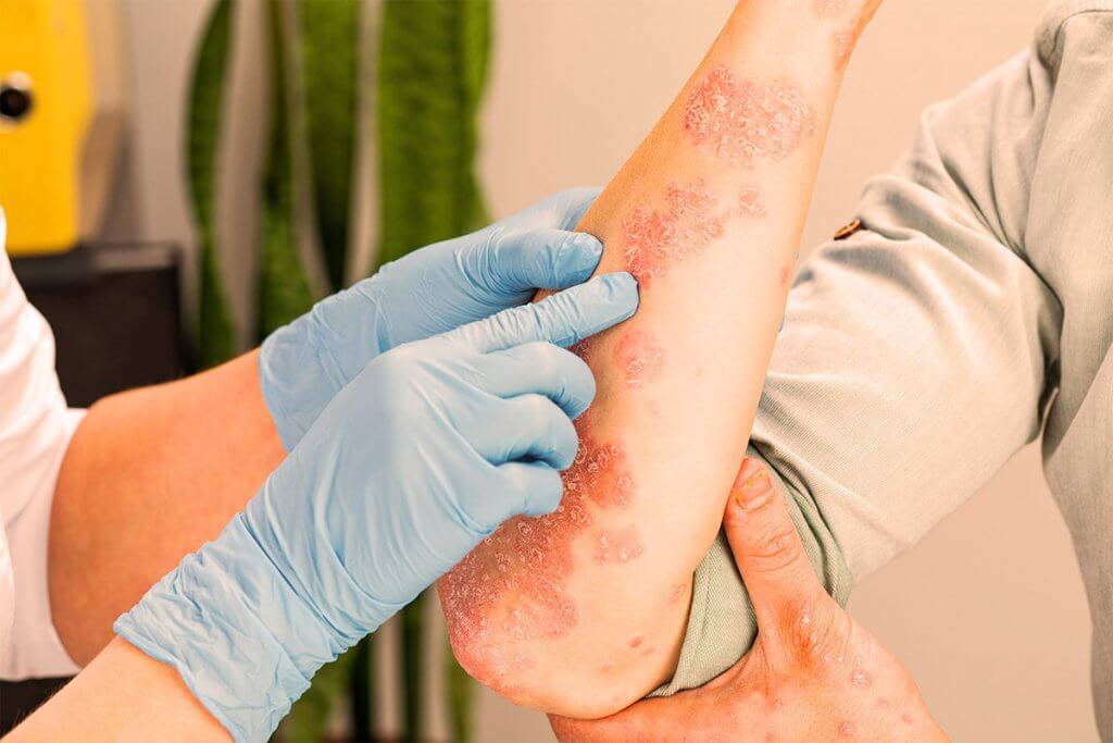 Psoriasis